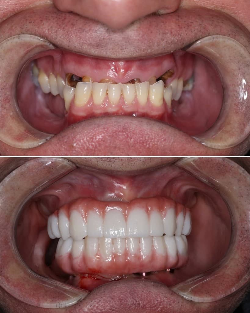 Before and after full-mouth dental restoration